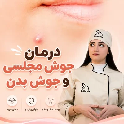 درمان جوش مجلسی